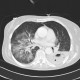 Abscessing pneumonia: CT - Computed tomography