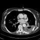 Abscessing pneumonia: CT - Computed tomography