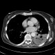 Abscessing pneumonia: CT - Computed tomography