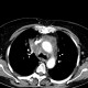 Pneumonia, mediastinitis, mediastinal abscess: CT - Computed tomography
