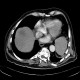 Abscess in liver, cholangoitis, maturation, first CT: CT - Computed tomography