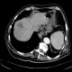 Abscess in liver, cholangoitis, maturation, first CT: CT - Computed tomography