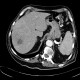 Abscess in liver, cholangoitis, maturation, first CT: CT - Computed tomography