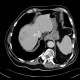 Abscess in liver, cholangoitis, maturation, second CT: CT - Computed tomography