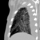 Accessory interlobium, pulmonary edema: CT - Computed tomography