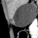 Adenomyosis of gallbladder, focal adenomyosis: CT - Computed tomography