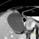 Adenomyosis of gallbladder, focal adenomyosis: CT - Computed tomography