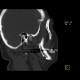 Accessory salivary gland, Stafne's defect: CT - Computed tomography