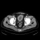 Cystitis, acute cystitis, bladder: CT - Computed tomography