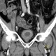 Cystitis, acute cystitis, bladder: CT - Computed tomography