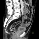 Cystitis, acute cystitis, bladder: CT - Computed tomography