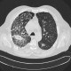Alveolar hemorrhage, ANCA vasculitis, paraseptal emphysema: CT - Computed tomography