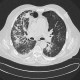 Alveolar hemorrhage, ANCA vasculitis, paraseptal emphysema: CT - Computed tomography
