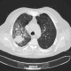 Alveolar hemorrhage, ANCA vasculitis, paraseptal emphysema: CT - Computed tomography