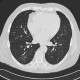 Alveolar hemorrhage, ANCA vasculitis, paraseptal emphysema, follow-up: CT - Computed tomography