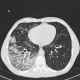 Alveolar lung edema, unilateral: CT - Computed tomography