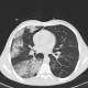 Alveolar lung edema, unilateral: CT - Computed tomography