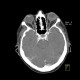 Retinal detachment, tumour of eyeball: CT - Computed tomography