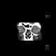 Retinal detachment, tumour of eyeball: CT - Computed tomography