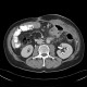 Mesenteric abscess, gastroenteroanastomosis, end-to-side, small-bowel stenosis: CT - Computed tomography