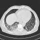 ANCA vasculitis, lung involvement: CT - Computed tomography
