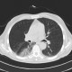 ANCA vasculitis, lung involvement: CT - Computed tomography