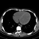 Anemia, heart: CT - Computed tomography
