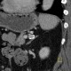 Aneurysm of lienal artery: CT - Computed tomography