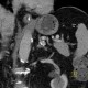 Aneurysm of lienal artery: CT - Computed tomography