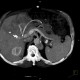 Aneurysm of lienal artery: CT - Computed tomography