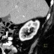 Angiomyolipoma of kidney, small: CT - Computed tomography
