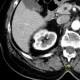Angiomyolipoma of kidney, small: CT - Computed tomography
