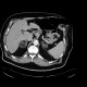 Angiomyolipoma, adenoma, adrenal adenoma, multiple: CT - Computed tomography