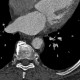 Plaques in the thoracic aorta, fibrous: CT - Computed tomography