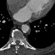 Plaques in the thoracic aorta, calcified: CT - Computed tomography