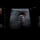 Acute appendicitis, appendicolith: US - Ultrasound