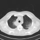 Angioinvasive aspergilosis: CT - Computed tomography