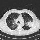 Angioinvasive aspergilosis: CT - Computed tomography