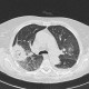 Angioinvasive aspergilosis, second CT: CT - Computed tomography