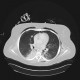 Aspergilosis of lung, crescent sign: CT - Computed tomography
