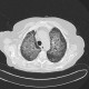 Atypical pneumonia, pneumocystis carini, HRCT: CT - Computed tomography
