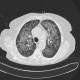 Atypical pneumonia, pneumocystis carini, HRCT: CT - Computed tomography