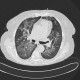 Atypical pneumonia, pneumocystis carini, HRCT: CT - Computed tomography