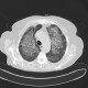 Atypical pneumonia, pneumocystis carini: CT - Computed tomography