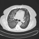 Atypical pneumonia, pneumocystis carini: CT - Computed tomography