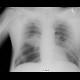 Atypical pneumonia: X-ray - Plain radiograph