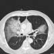 Atypical pneumonia: CT - Computed tomography