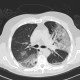 Atypical pneumonia, influenza, H1N1: CT - Computed tomography