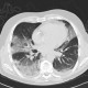 Atypical pneumonia, influenza, H1N1: CT - Computed tomography