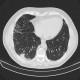 Atypical pneumonia, influenza, H1N1, 10 months after: CT - Computed tomography